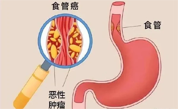 食管恶性肿瘤患者麻醉管理:如何平衡风险与安全性?