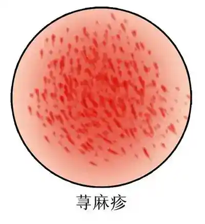 年轻<span style="color: #da4707">女性</span>的慢性荨麻疹<span style="color: #da4707">预防</span>与治疗