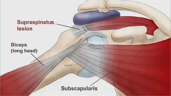 “肩袖损伤揭秘——你不知道的危害与预防！”