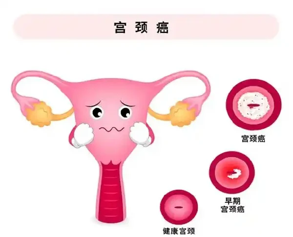 全面了解宫颈癌：从诊断到管理的全程科普