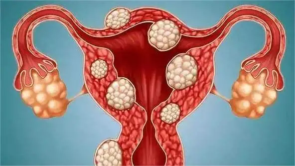 子宫肌瘤知多少?揭开女性健康的“沉默杀手”
