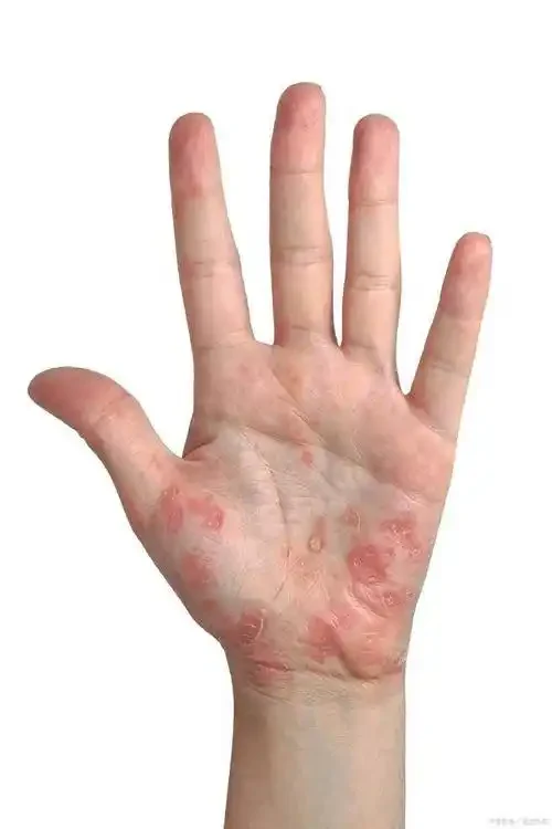 湿疹样皮炎：解读症状与日常预防指南