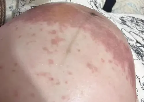 湿疹孕期护理：让准妈妈安心过渡