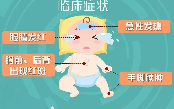 小心孩子的川崎病—冠状动脉扩张的“幕后黑手”