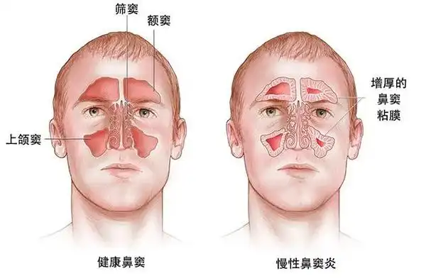 鼻窦炎及过敏性鼻炎的药物治疗揭秘！封面图
