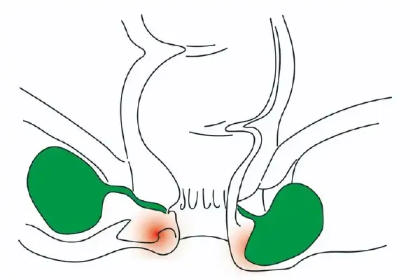 全面解析肛周脓肿及其治疗方法