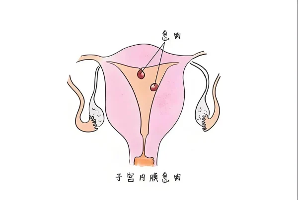 解密子宫内膜息肉:女性健康的隐形敌人