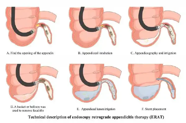 警惕急性阑尾炎:年轻人也不能忽视的健康警报