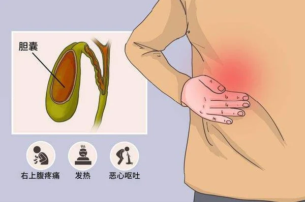 慢性胆囊炎与高脂血症的管理:科学与实践
