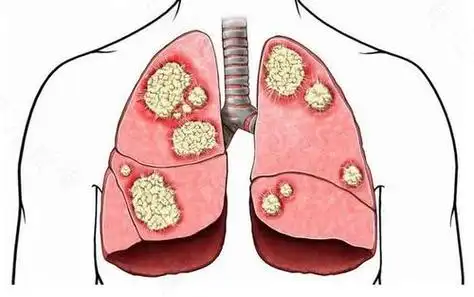 全面了解肺癌：从诊断到管理