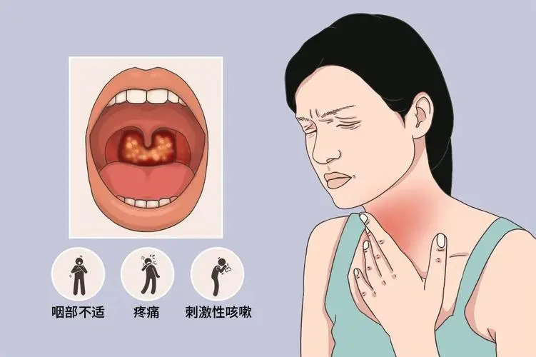 全面解读急性咽炎:病因、症状与治疗