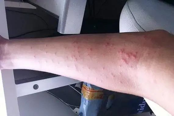 慢性荨麻疹的全面管理与治疗策略