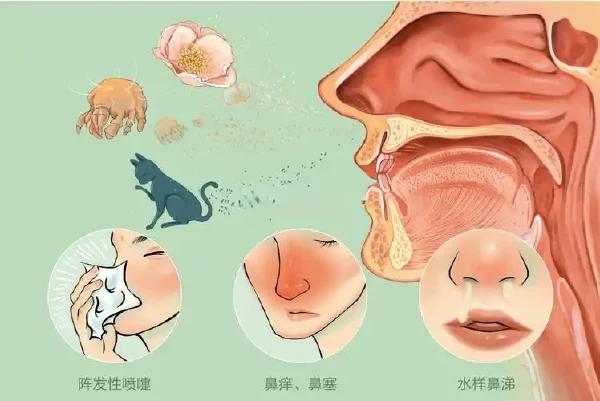 如何预防和治疗变应性鼻炎和急性上呼吸道感染