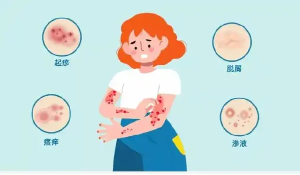 过敏性皮炎：全面解析与防治策略