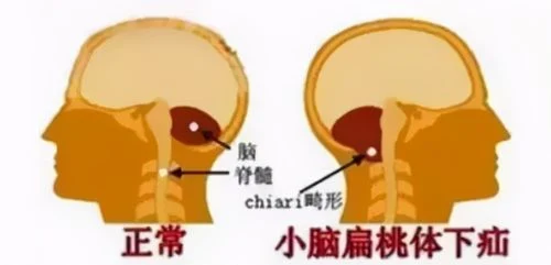 小脑扁桃体下疝畸形！脊髓空洞，让我们一探究竟