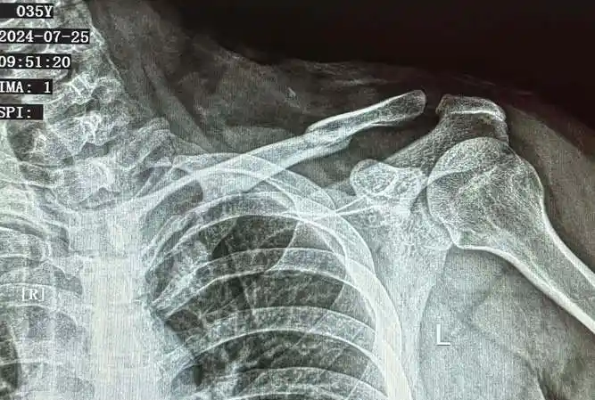 锁骨骨折术后需关注的那些事儿，还不赶紧点进来！封面图