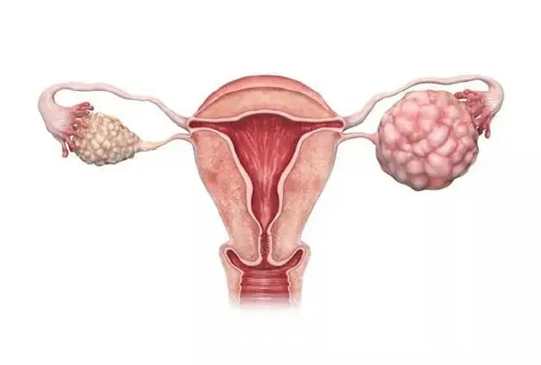 早期发现，及时治疗——卵巢癌诊疗的重要性！