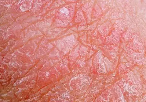 面部及颈部红斑瘙痒:皮炎的防治知多少