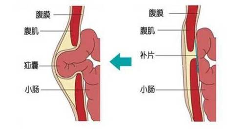 认识腹股沟疝：分类、诊断、治疗与管理