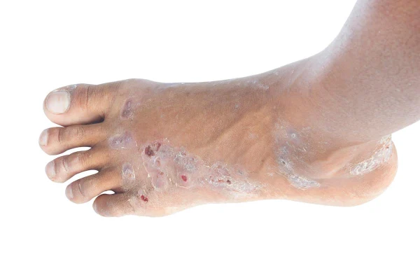 摆脱皮肤烦恼:全面解析特应性皮炎和足癣