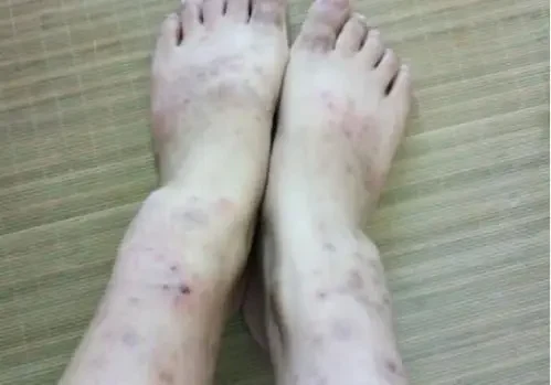 皮炎：隐形的皮肤杀手