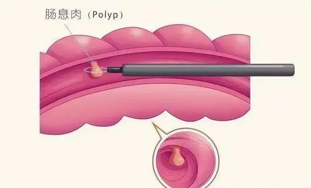摆脱直肠息肉的干扰：从病因到预防全面解析封面图