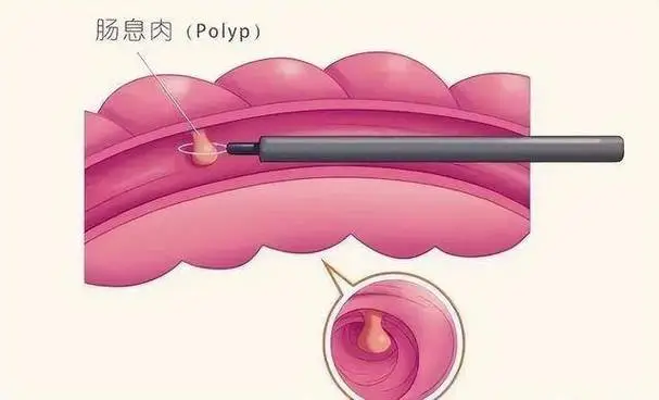 摆脱直肠息肉的干扰：从病因到预防全面解析