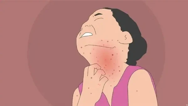 面部再发性皮炎：原因、治疗与预防完全指南