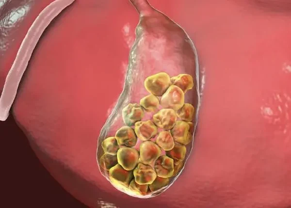 胆囊结石嵌顿：精准诊断与治疗路径详解