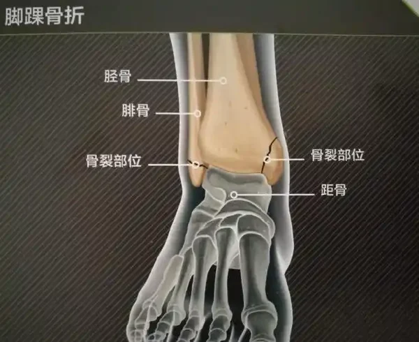 踝关节骨折的诊断与治疗：全面指南