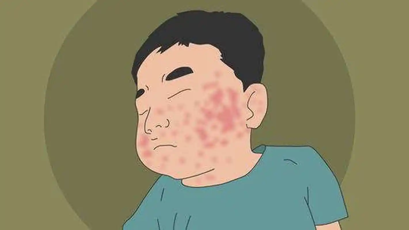 慢性荨麻疹：不容忽视的瘙痒困扰封面图