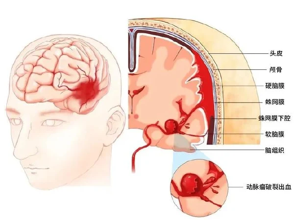 动脉瘤性蛛网膜下腔出血的全面解读：从诊断到治疗
