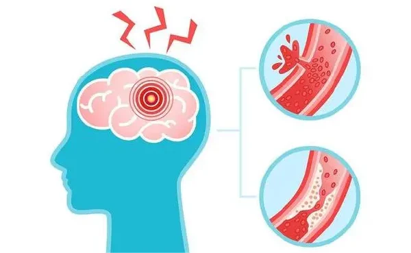 颅内出血与骨折:综合治疗和管理指南