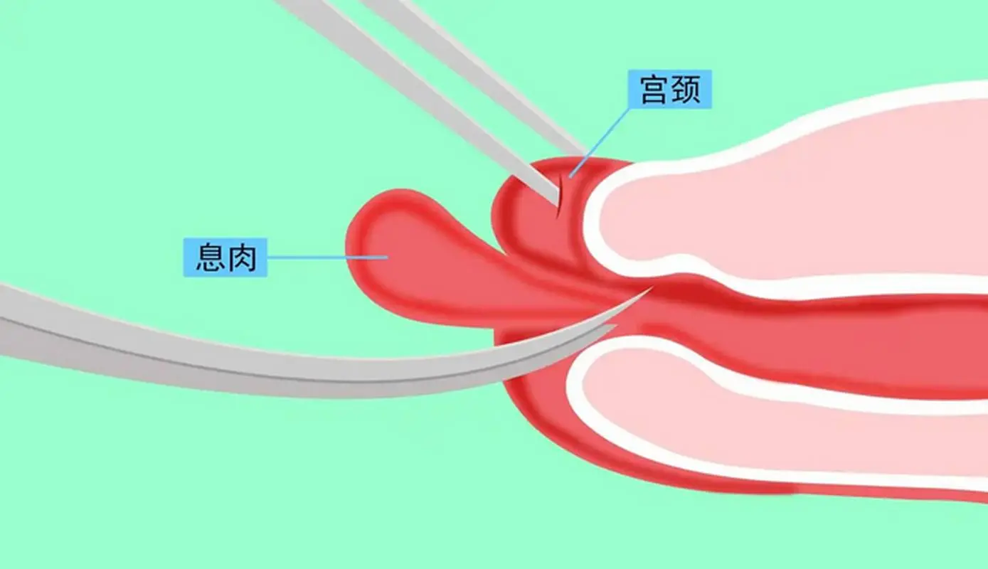 宫颈息肉：全面了解及科学管理封面图