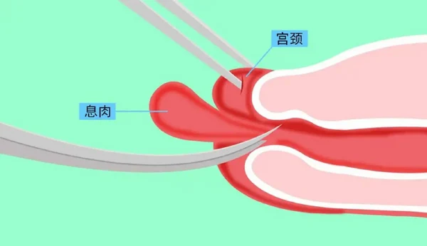 宫颈息肉：全面了解及科学管理
