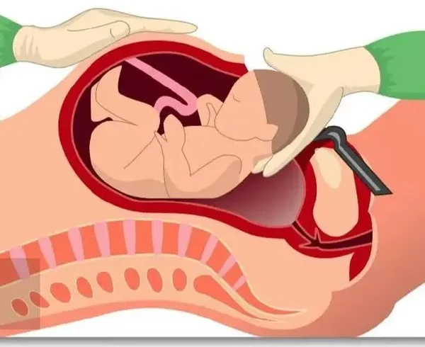 孕足月的剖宫产手术—了解手术记录，守护孕妈健康！