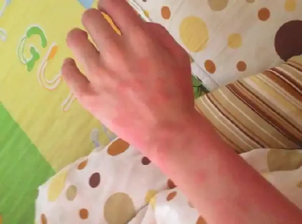 荨麻疹的秘密：了解慢性荨麻疹并有效应对