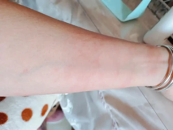 慢性荨麻疹：理解与应对