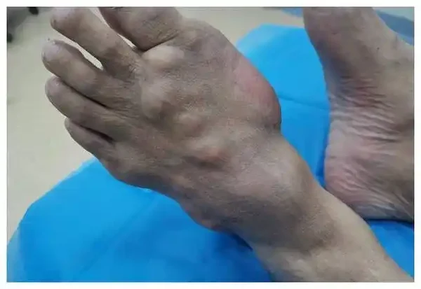 关注健康,预防痛风:全面了解痛风的症状、诊断和预防