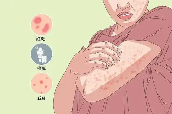 丘疹性荨麻疹与荨麻疹:了解与防治