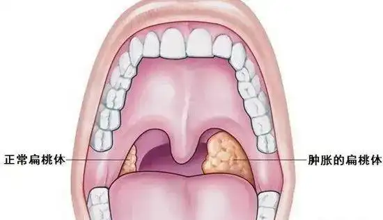 扁桃体炎的类型与治疗：全面解析
