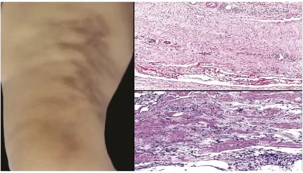 潜伏在皮肤下的敌人——结节性脂膜炎