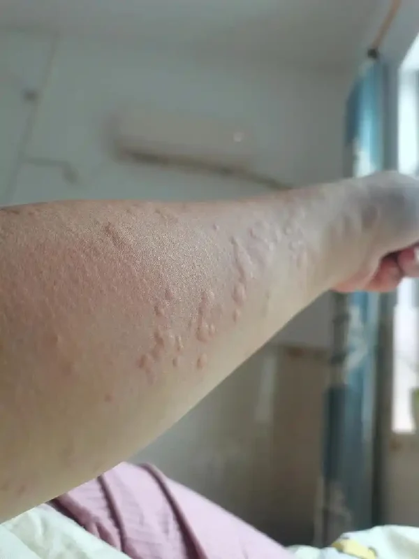 全方位解析急性荨麻疹的诊疗与管理