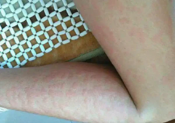 慢性荨麻疹:全面解析与防治
