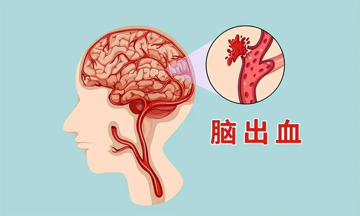 全面解析脑出血：从诊断到管理