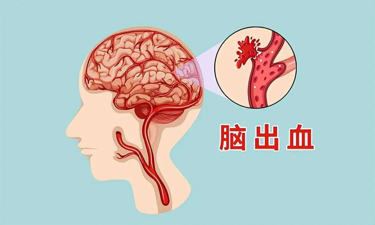 全面解析<span style="color: #da4707">脑出血</span>：从诊断到管理