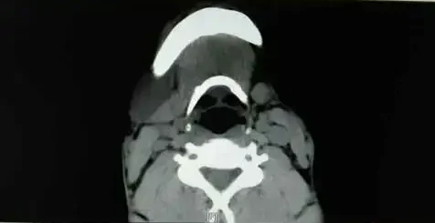 揭秘颌下腺囊肿：你需要知道的一切