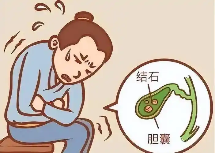 胆石症：病因、诊断与管理