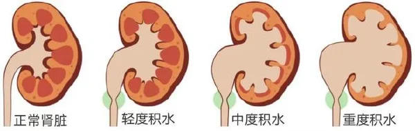 全面解读右肾结石伴积水和感染：从诊断到治疗