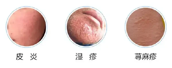 了解面部皮炎:什么是它,如何预防和治疗?